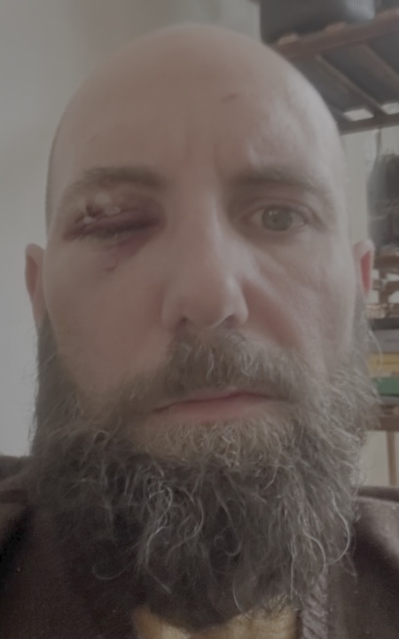 Injuries sustained during the assault